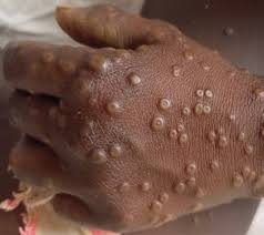 12 new cases of Mpox confirmed; total now 980 – Ghana Health Service